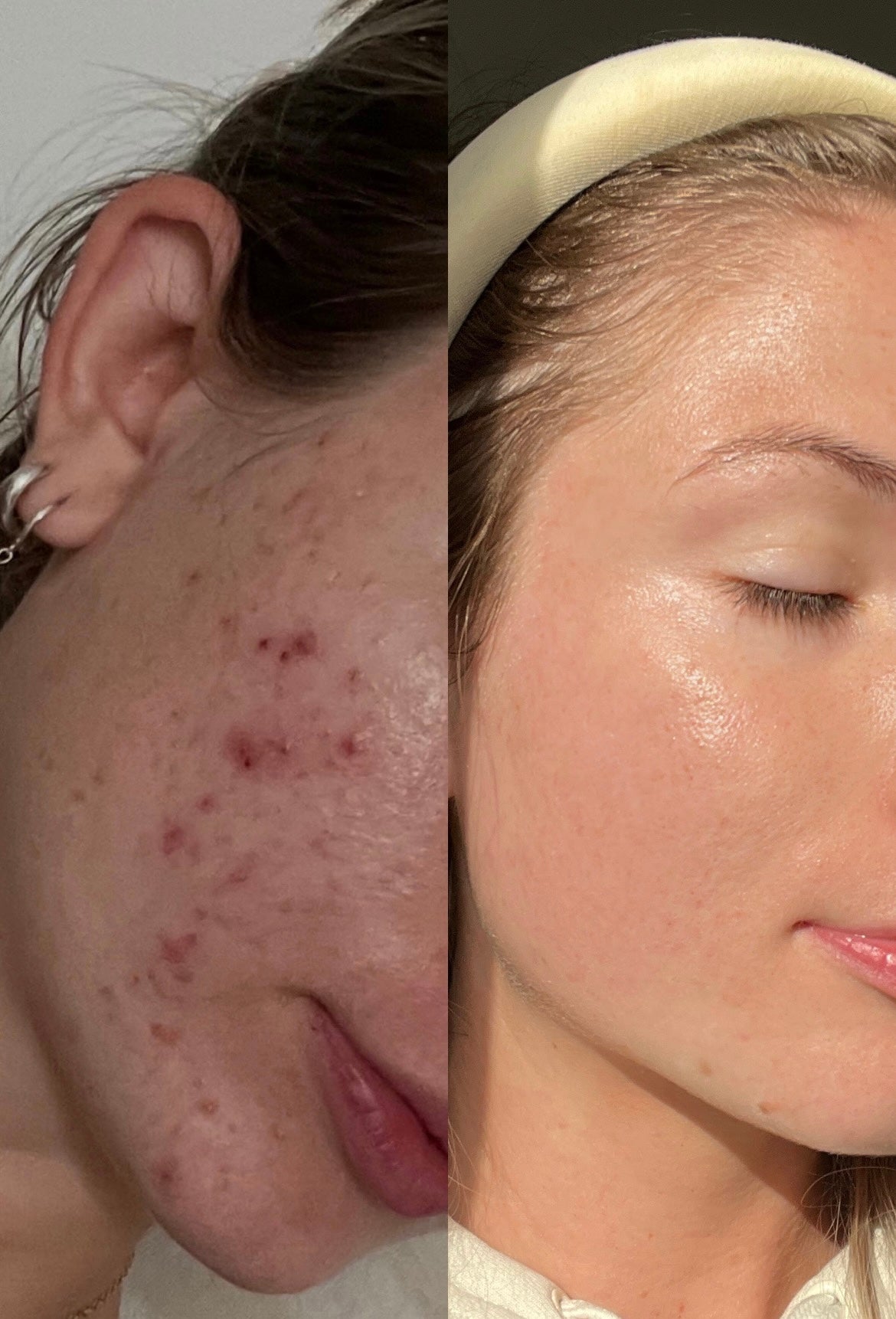 Bye-Bye Blemishes Trio