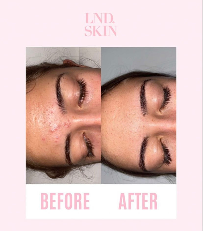 Hydrogel Cooling Face Mask