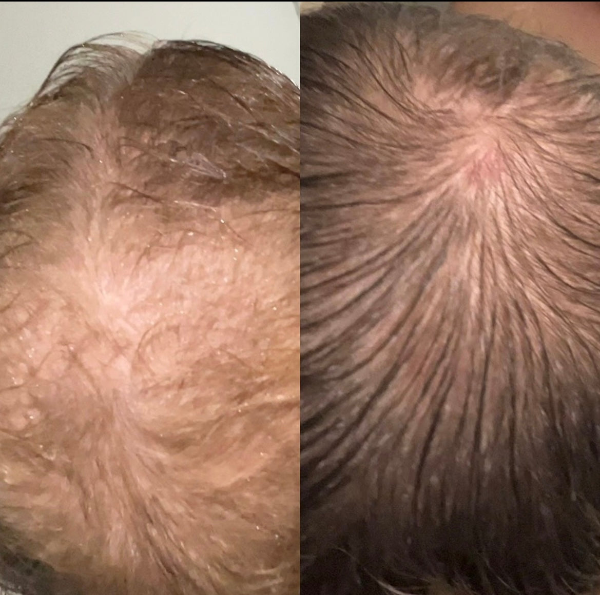 BARE Follicle Revival Hair Growth Oil (Limited Edition)