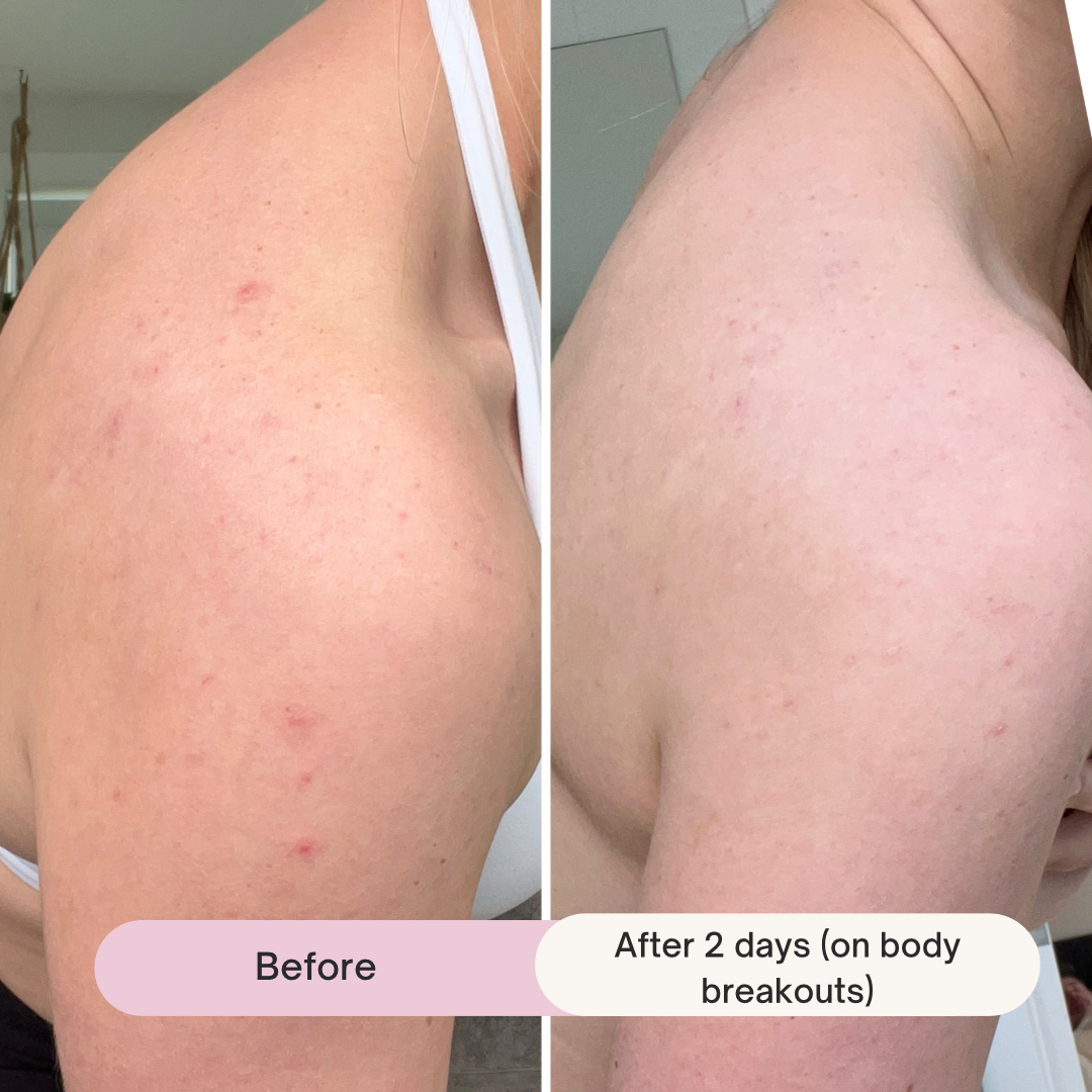 Breakout Boss Soothing Spot Gel